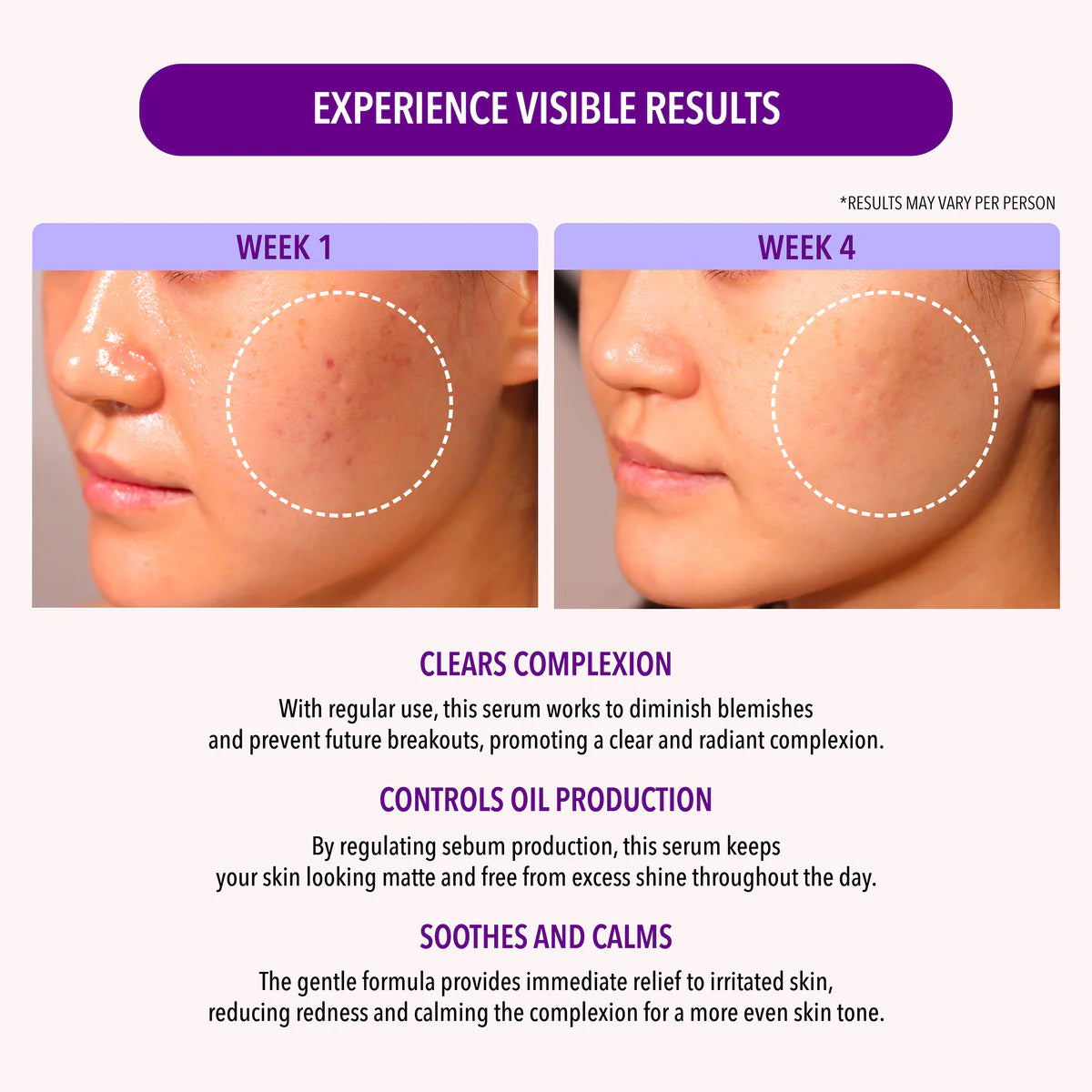 10% NIACINAMIDE & 1.9% SALICYLIC ACID OIL CONTROL SERUM MOIRA