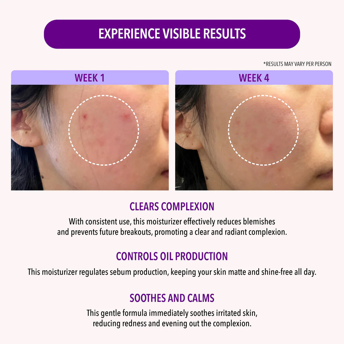 10% NIACINAMIDE OIL CONTROL MOISTURIZER MOIRA